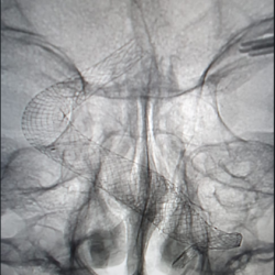  Uložený stent.