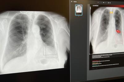Umělá inteligence (AI) přináší revoluční změny do medicíny. V posledních letech se stává klíčovým faktorem v diagnostice a léčbě nemocí. Jedním z příkladů, jak AI mění zdravotnickou praxi, je systém Carebot, který používají na radiologickém oddělení v Nemocnici Tábor, a.s.